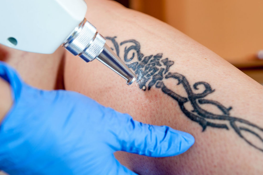 How Does Tattoo Removal Actually Work?